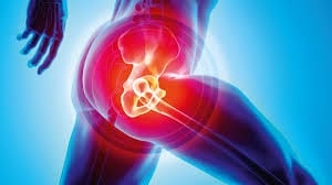 How Do You Know If You Need A Hip Replacement?